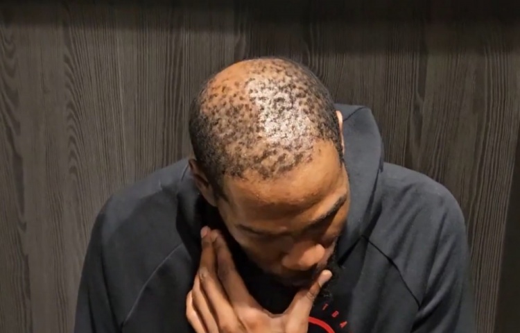 世界杯历史比分-37岁还单身有原因😳！杜兰特秃顶这么严重 这发量找对象难啊